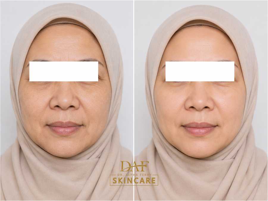 Perawatan bebas kerutan DAF Skincare
